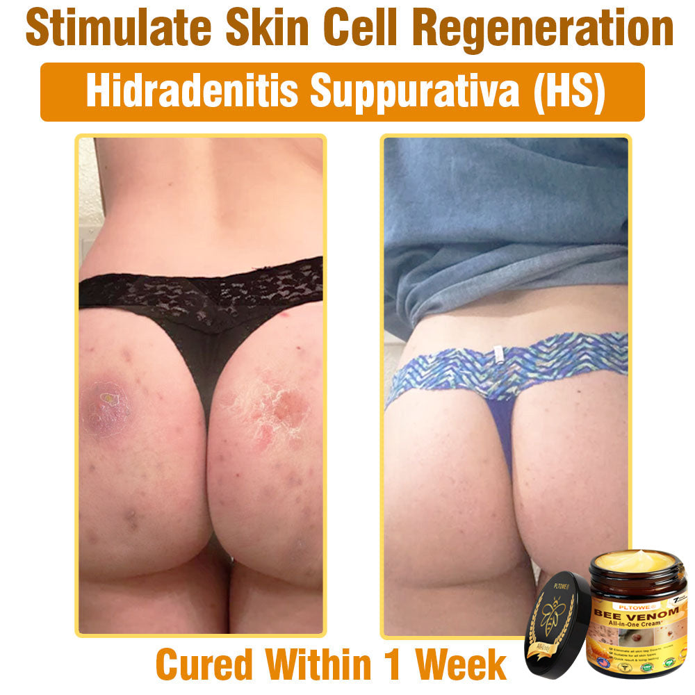 Only 5 jars! Grab an exclusive 50% discount now! Keep your skin youthful and glowing in just 1 to 4 weeks. Donāt miss your chanceāthis offer wonāt come around again until next year. Act fast! 180-day money back guarantee!