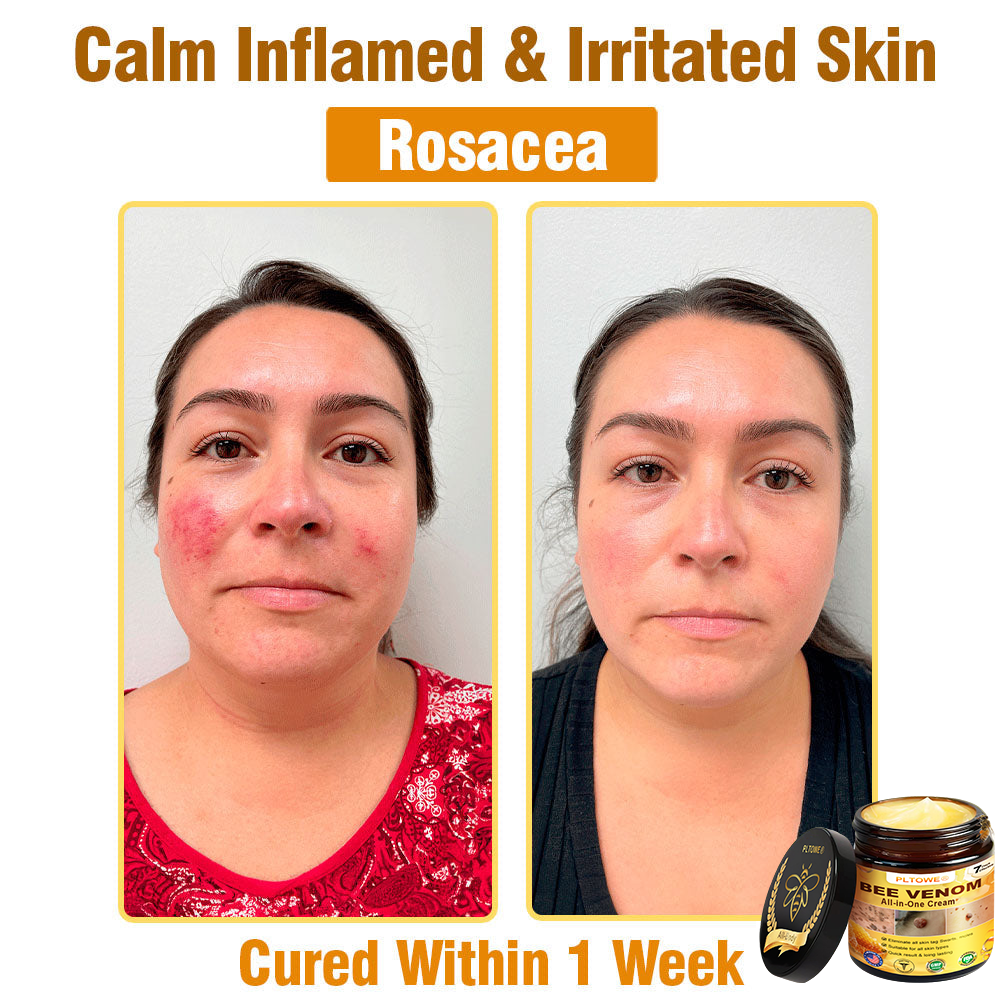 Only 5 jars! Grab an exclusive 50% discount now! Keep your skin youthful and glowing in just 1 to 4 weeks. Donāt miss your chanceāthis offer wonāt come around again until next year. Act fast! 180-day money back guarantee!